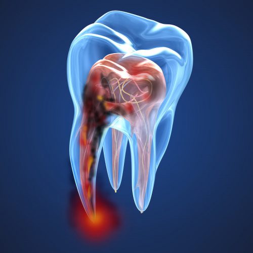 Damaged teeth xray view. Medically accurate tooth 3D illustration Damaged teeth xray view. Medically accurate tooth 3D illustration